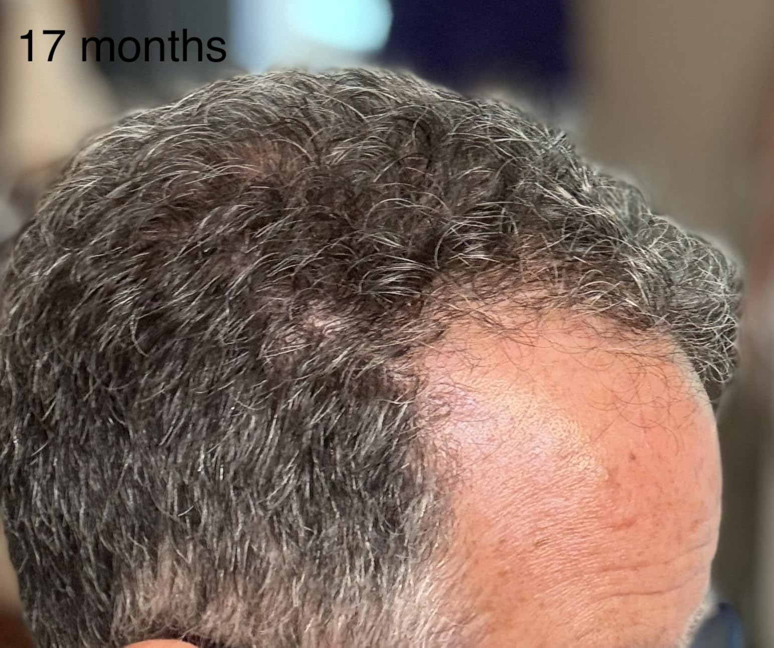 iRestore Professional Laser Red Light Therapy for Hair Growth System - FDA Cleared Hair Loss, Hair Thinning & Alopecia Treatment for Men & Women - 282 Lasers & LEDs customer photo 2