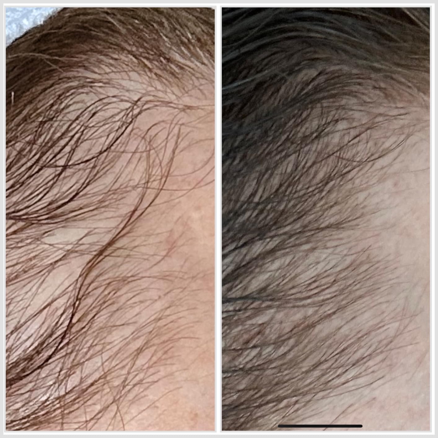 Hairmax LaserBand 82 - Hair Growth and Regrowth Treatment - Restores Natural Hair Cycle - Home-Use Medical Device With Medical Grade Lasers customer photo 1
